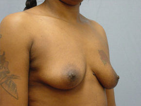 Breast Augmentation Saline
