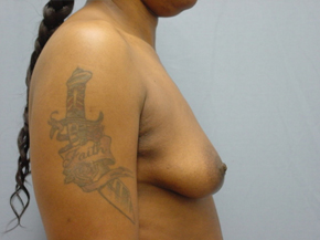 Breast Augmentation Saline