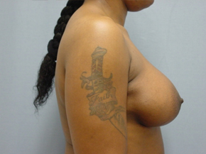 Breast Augmentation Saline