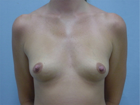 Breast Augmentation Saline
