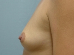 Breast Augmentation Saline
