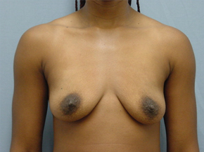 Breast Augmentation Saline