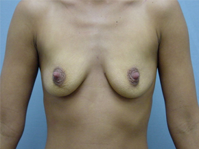 Breast Augmentation Saline
