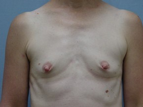 Breast Augmentation Saline