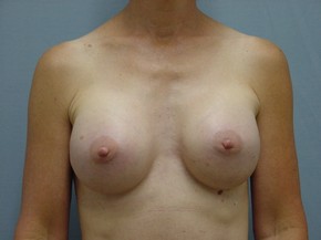 Breast Augmentation Saline