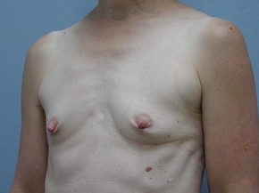 Breast Augmentation Saline