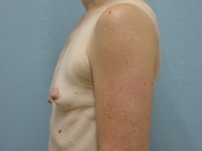 Breast Augmentation Saline
