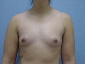Breast Augmentation Saline