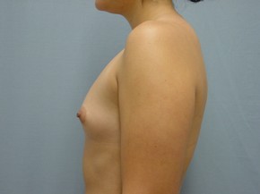 Breast Augmentation Saline