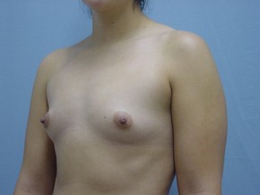 Breast Augmentation Saline