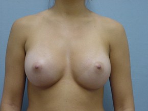 Breast Augmentation Saline