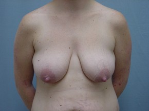 Breast Lift