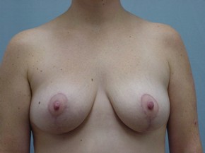 Breast Lift