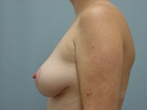 Breast Lift