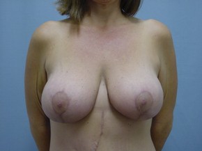 Breast Lift