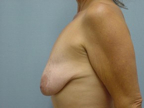 Breast Lift