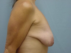 Breast Lift