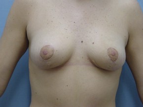 Breast Lift