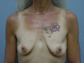 Breast Lift