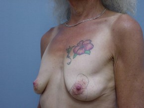 Breast Lift