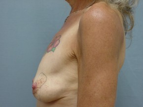 Breast Lift