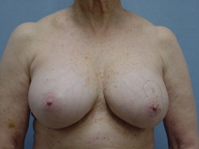 Breast Lift