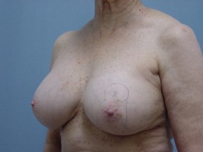 Breast Lift