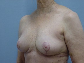 Breast Lift