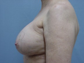 Breast Lift