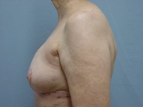Breast Lift