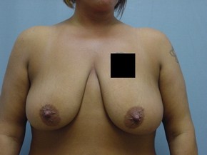 Breast Lift