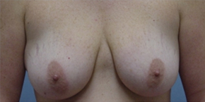 Breast Lift