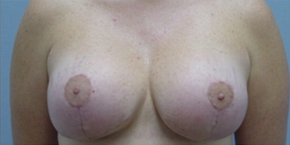 Breast Lift