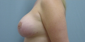 Breast Lift