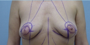 Breast Lift