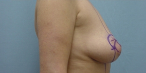 Breast Lift