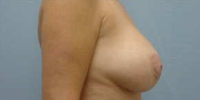 Breast Lift