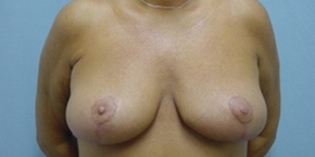 Breast Lift