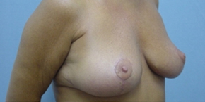 Breast Lift