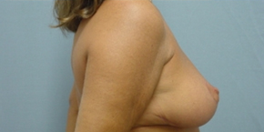 Breast Lift