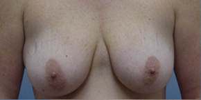 Breast Lift