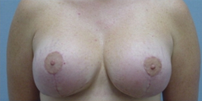 Breast Lift