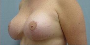 Breast Lift