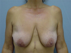 Breast Lift