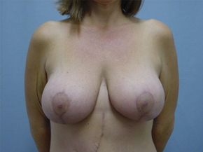 Breast Lift