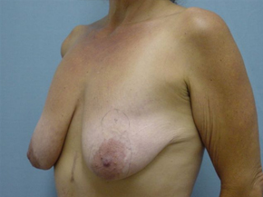 Breast Lift