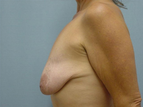 Breast Lift