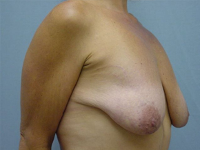 Breast Lift