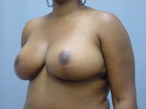 Breast Reduction