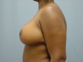 Breast Reduction
